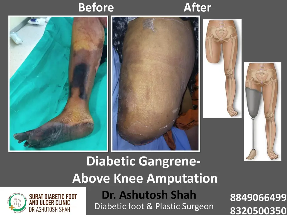 Diabetic Foot  PPT sunita.pptx-19.webp